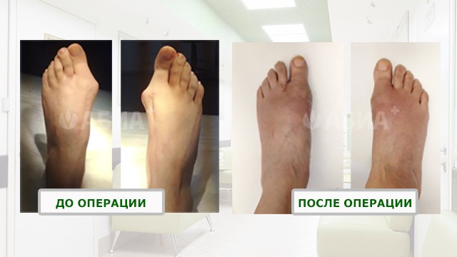 Хирургия стопы до и после