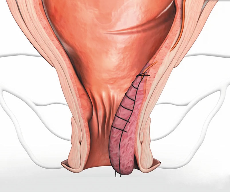Дезартеризация геморроя HAL-RAR