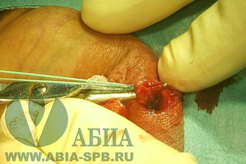 Вазэктомия или мужская стерилизация