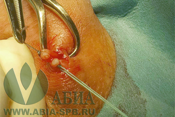 Вазэктомия, как способ контрацепции