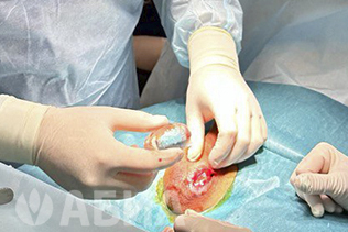 Операция по эндопротезированию яичка