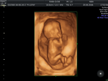 3d/4d узи в клинике АБИА