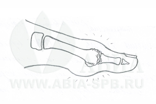 Деформирующий остеоартроз 3 степени