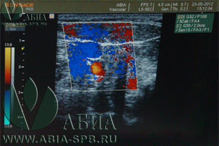 Дуплекс, триплекс сосудов