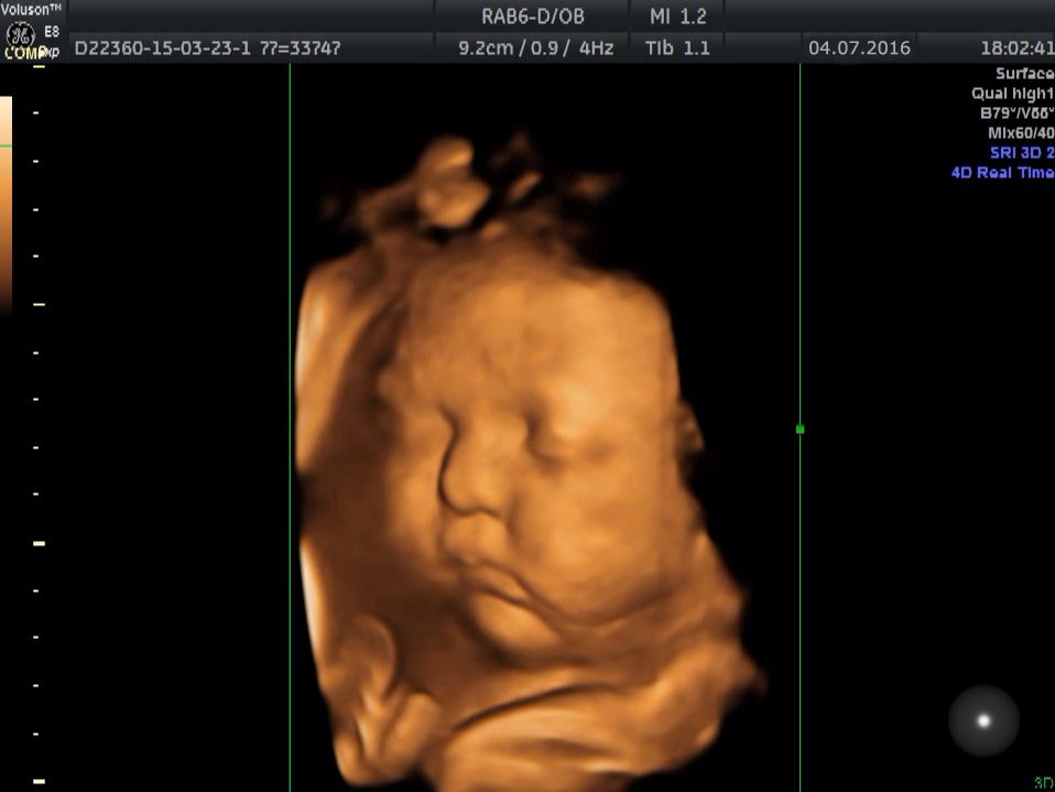 3d/4d узи в клинике