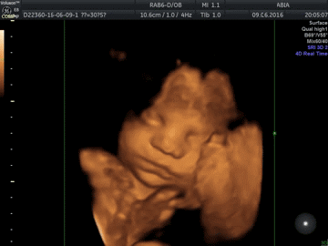 УЗИ беременным на аппарате VolusonE8 Expert
