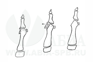 Хейлэктомия