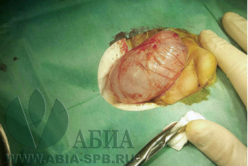 Водянка яичка у ребенка