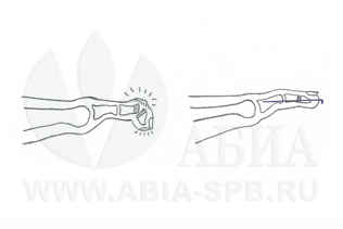 Когтистый палец