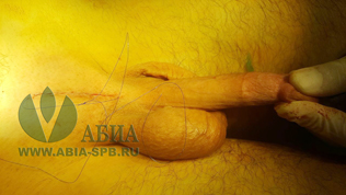 Лигаментотомия лобковым доступом