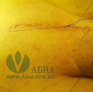 Лигаментотомия: лобковый доступ