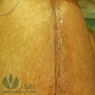 Лигаментотомия: мошоночный доступ