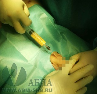 Липофилинг полового члена