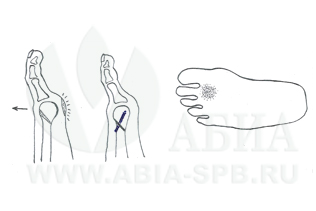 Патологические натоптыши - косая остеотомия по Weil