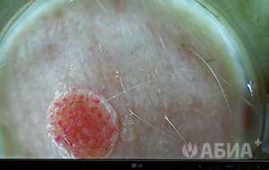 Цифровая видеодерматоскопия. Исследование родинок