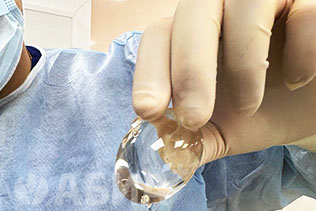 Эндопротез мужского яичка фирмы Eurosilicone