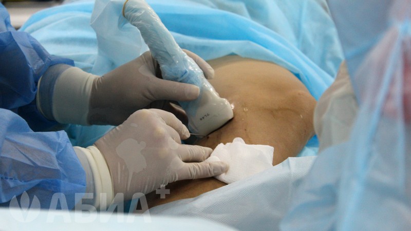 Радиочастотная облитерация вен