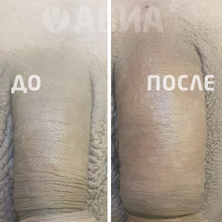 Утолщение полового члена гиалуроновой кислотой