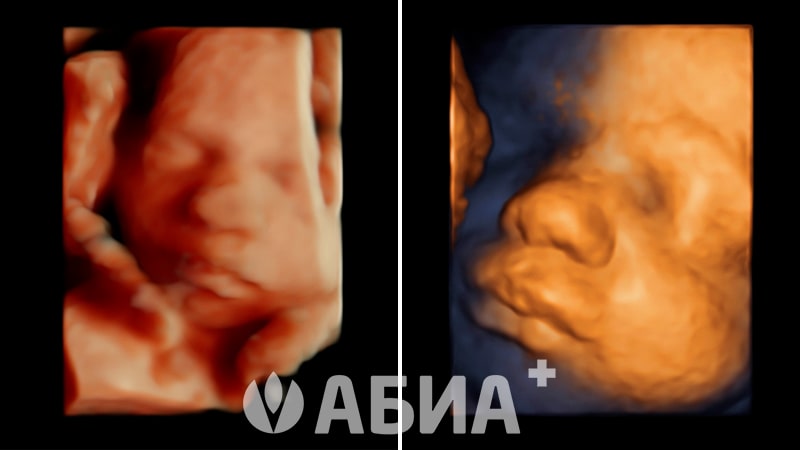 Первая встреча - 3D УЗИ плода
