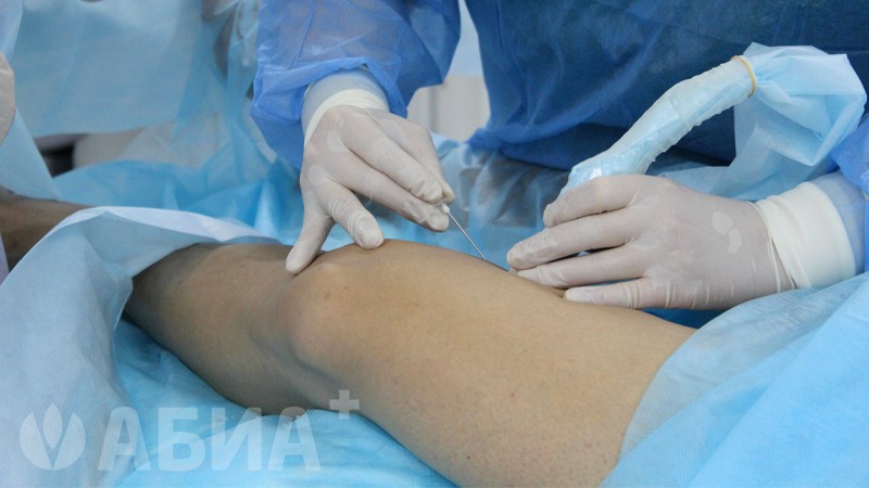 Радиочастотная облитерация вен