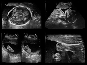 УЗИ скрининг третьего триместра беременности