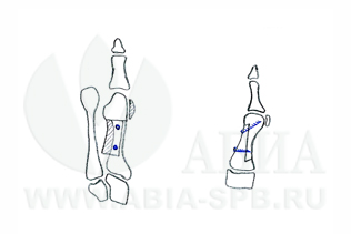 Z-образная остеотомия (Scarf) - вид сверху, вид сбоку